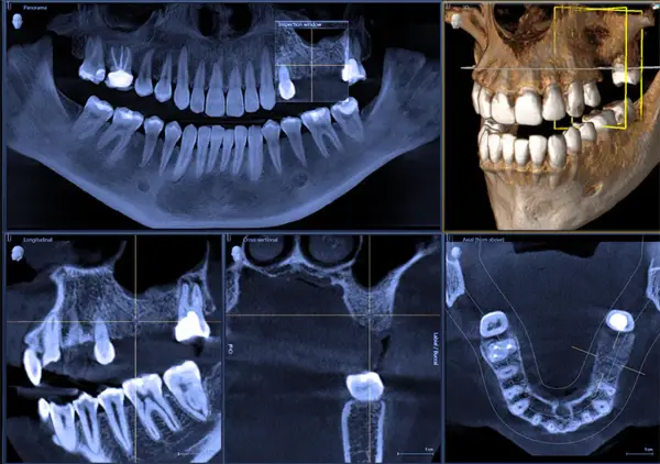 Tomografia CBCT prezentuje obraz zębów i szczęki w przekrojach: panoramicznym, osiowym, strzałkowym i poprzecznym.