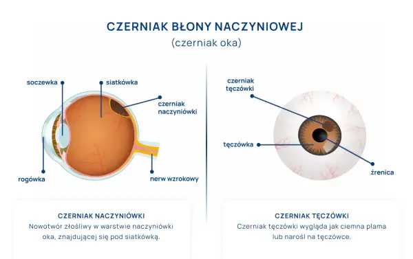 Ilustracje przedstawiają czerniaka oka: czerniak naczyniówki pod siatkówką i czerniak tęczówki. Ból oka może być objawem.