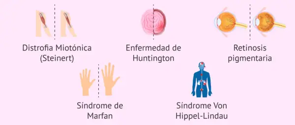 Ilustraciones de distrofia miotónica, Huntington, Marfan, Von Hippel-Lindau y retinosis pigmentaria, ejemplos de herencia autosomica dominante.