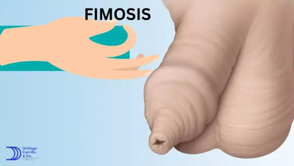 Ilustración de fimosis, una condición que puede afectar a niños. Se muestra un prepucio retraído y la acumulación de esmegma.