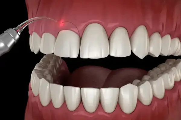 Gingiwektomia - Kiedy usuwanie dziąsła ratuje uśmiech?