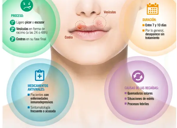 Herpes labial por estrés: el proceso incluye picor, vesículas y costras. Las recaídas pueden ser por estrés.
