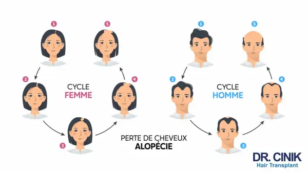 Illustration du cycle de perte de cheveux chez l'homme et la femme, montrant l'impact de la dht hormone sur l'alopécie.