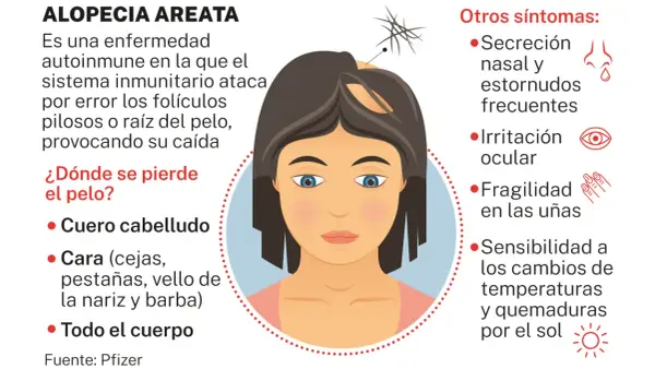 Ilustración de una mujer con alopecia areata, mostrando la pérdida de cabello en el cuero cabelludo y otros síntomas.