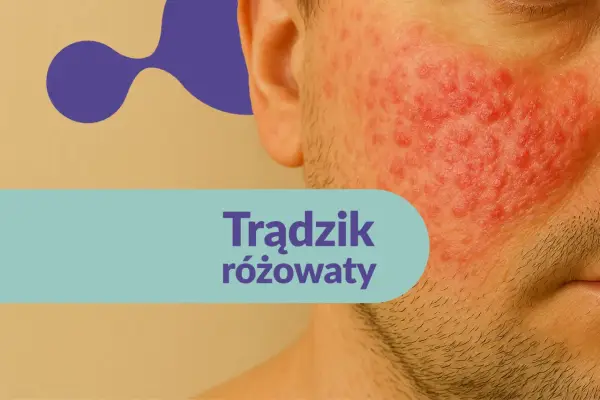 Trądzik różowaty na twarzy. Szukasz informacji o rozex krem opinie?