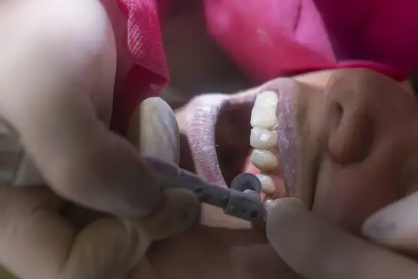 Dentysta wygładza ostry brzeg kości po usunięciu zęba, używając małego wiertła.