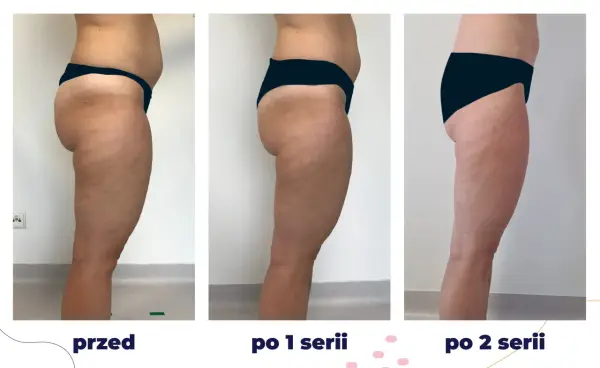 Efekty zabiegu iCoone na uda: przed, po 1 i po 2 seriach. Widoczna redukcja cellulitu i poprawa jędrności skóry.