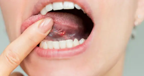 Ból i obrzęk pod językiem - Kiedy do dentysty?