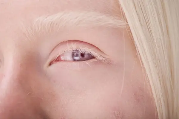 Blond włosy i jasne brwi otaczają fioletowe oczy, świadczące o albinizmie.