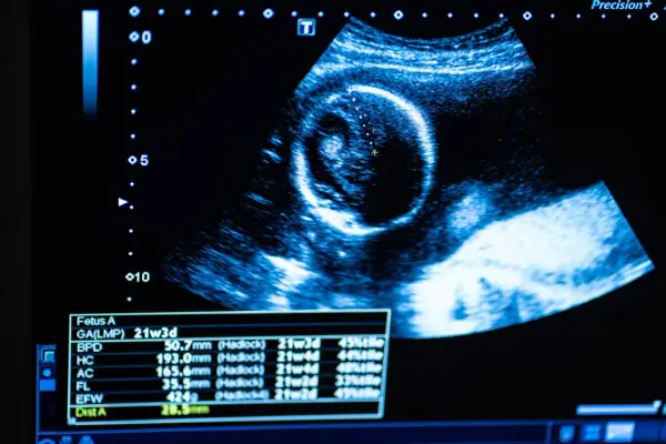 Obraz usg ciąży pokazuje rozwijający się płód. Na ekranie widoczne są pomiary i wiek ciąży.
