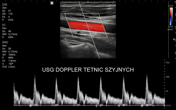 Obraz przedstawia badanie USG doppler tętnic szyjnych z widocznym przepływem krwi w czerwonych i niebieskich barwach oraz wykresem prędkości.