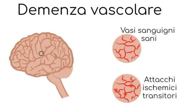 Illustrazione del cervello con un cerchio che indica un'area interessata da vasculopatia cerebrale cronica nell'anziano. Confronto tra vasi sanguigni sani e quelli colpiti da attacchi ischemici transitori.