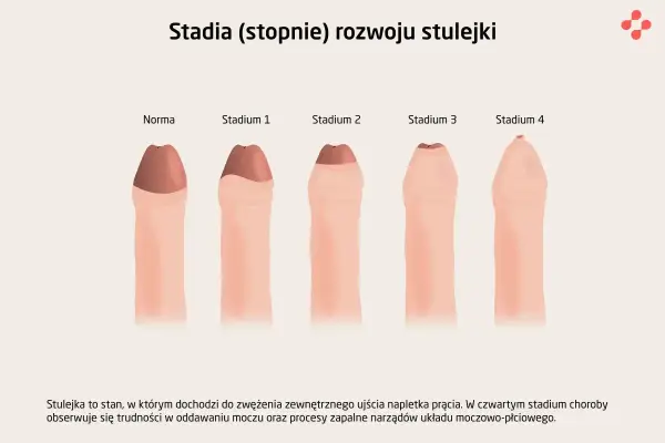 Stulejka - kiedy to norma, a kiedy wymaga leczenia?