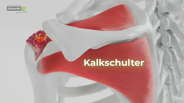 Kalkschulter: Ablagerungen im Schultergelenk. Was tun? Hier sehen Sie die Ursache von Schulterschmerzen.