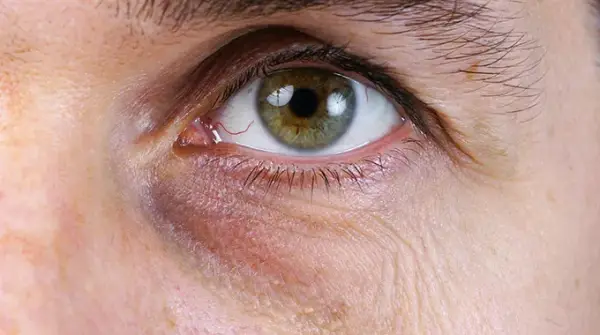 Eisenmangel symptome augen: Dunkle Augenringe und ihre Ursachen erkennen