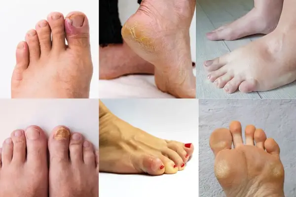 La podologia cos'è? Immagini di piedi con unghie incarnite, talloni screpolati, funghi, calli e gonfiore.