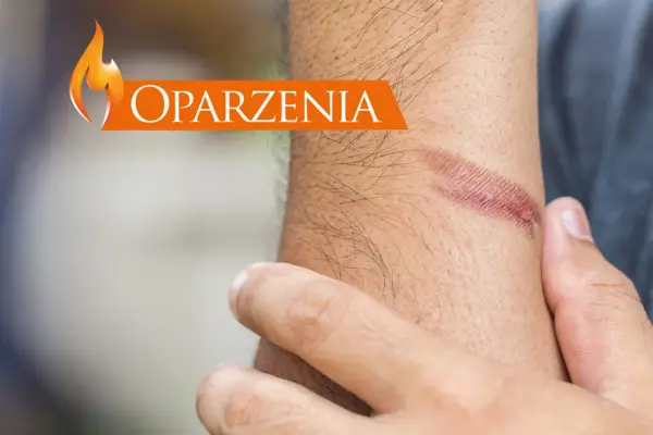 Oparzenia na skórze. Dowiedz się, jak udzielić pierwszej pomocy przy oparzeniach, aby zminimalizować szkody.