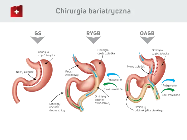 Ilustracja porównuje trzy typy operacji bariatrycznych: GS, RYGB, OAGB. Dowiedz się, ile kosztuje operacja bariatryczna i jakie są jej rodzaje.