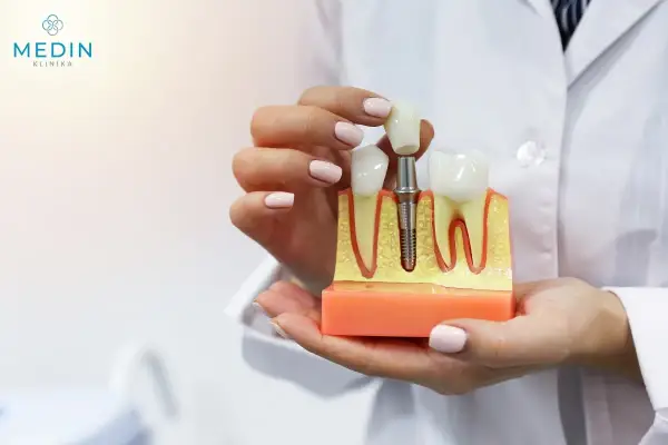 Model szczęki z implantem i koroną. Pokazuje, jak wygląda sinus lift otwarty, przygotowujący do wszczepienia implantu.