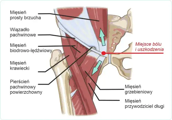 Anatomia mięśni pachwiny i biodra. Czerwona kropka wskazuje miejsce bólu i uszkodzenia, często związane z problemami, które powodują ból lędźwi.