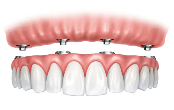 Arcata dentale superiore con impianti dentali. La protesi superiore si aggancia a quattro pilastri metallici.