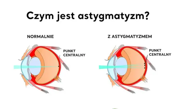 Astygmatyzm: okulary czy soczewki? Porównaj i wybierz mądrze!