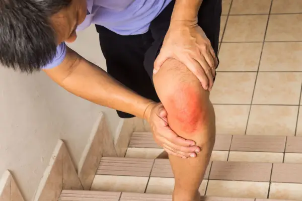 Hemochromatoza i objawy skórne - Jak rozpoznać nadmiar żelaza?