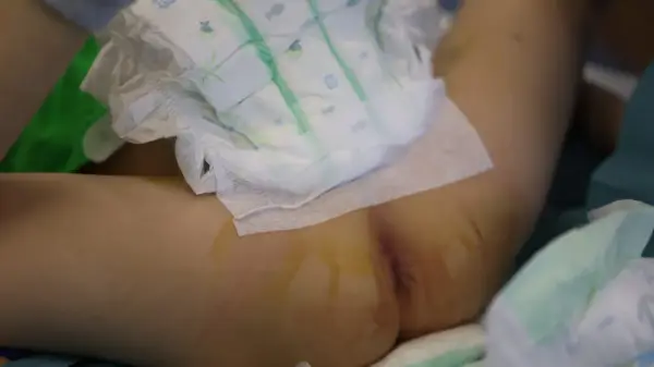 Niemowlę w pieluszce, które 3 latek sika 2 razy dziennie, leży na boku. Widoczne są ślady po wkłuciach.