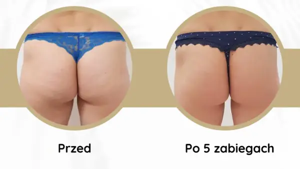Widoczne **efekty endermologii po 6 zabiegach** na pośladkach. Skóra jest gładsza, bardziej jędrna i napięta.