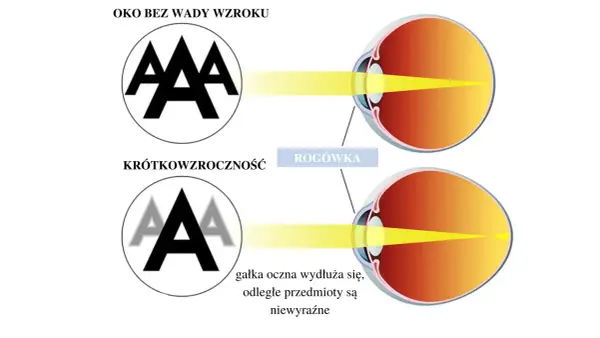 Ostrość wzroku 1.0 - co oznacza i czy to idealny wzrok?