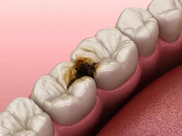 Dente cariato con cavità scura che raggiunge la polpa dentale.