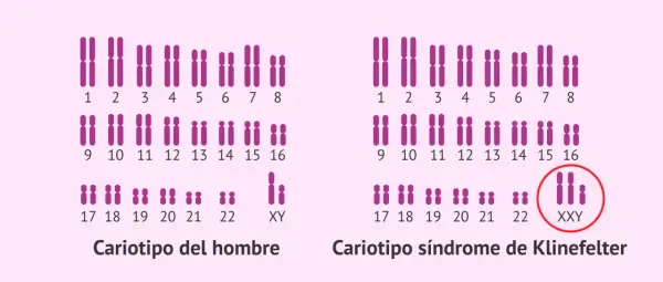 Cariotipo de hombre con cromosomas XY y cariotipo de síndrome de Klinefelter con XXY.