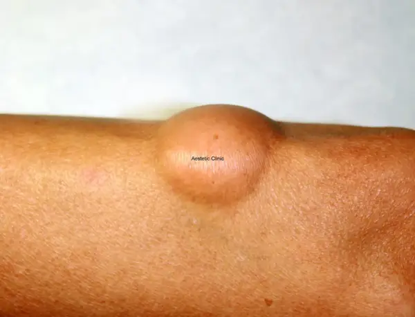Widoczny na skórze łagodny tłuszczak (lipoma) – okrągłe, cieliste zgrubienie.
