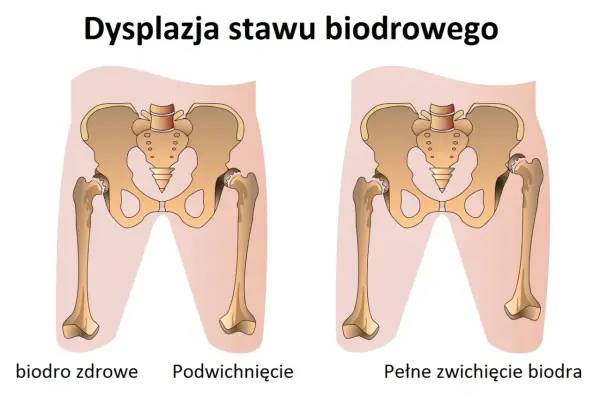 Ilustracja porównuje zdrowe biodro z dysplazją stawu biodrowego u dorosłych, pokazując podwichnięcie i pełne zwichnięcie.