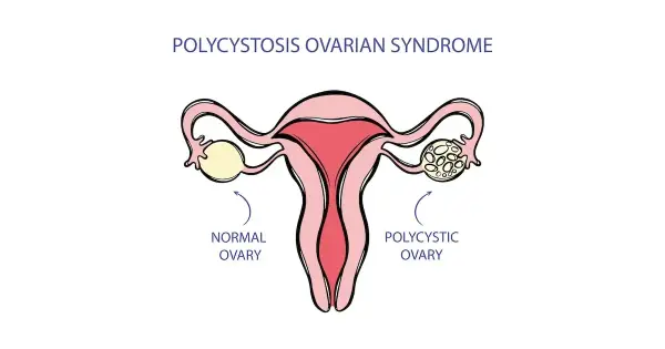 PCOS: jakie badania krwi są kluczowe dla diagnozy i zdrowia jajników?