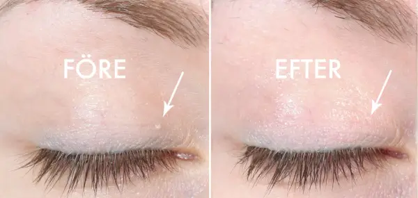 Före och efter: en vit prick i ansiktet, nära ögat, har behandlats.