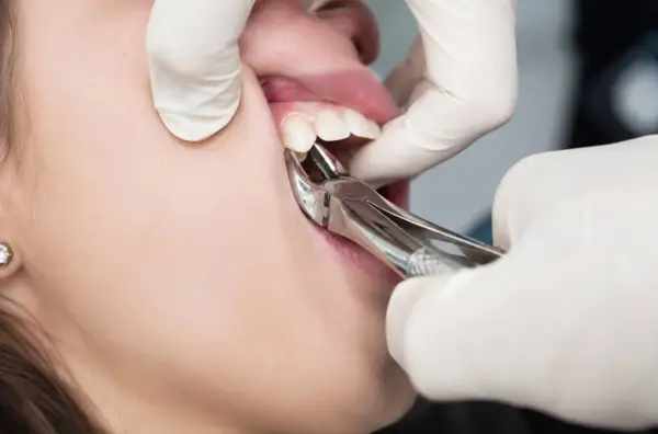 Chirurgiczne usuwanie zęba w trakcie zabiegu. Dentysta w białej rękawiczce używa kleszczy stomatologicznych.