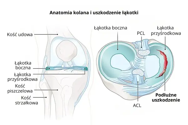 Anatomia kolana z widocznym podłużnym uszkodzeniem łąkotki przyśrodkowej.