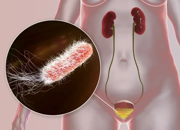 Gros plan sur un germe responsable d'une infection urinaire, montrant sa structure filamenteuse. Le système urinaire humain est également représenté.