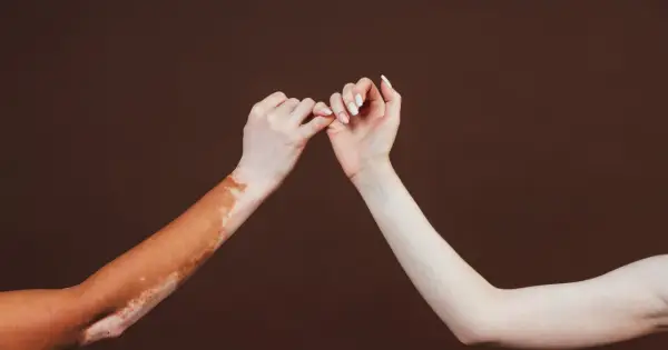 Dwie ręce splatają palce. Jedna z nich ma widoczne plamy vitiligo, symbolizujące różnorodność i akceptację.