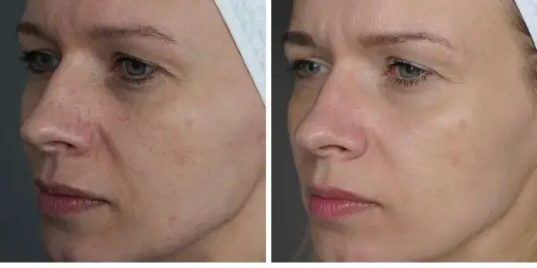 Przed i po zabiegu laserem frakcyjnym. Widoczna poprawa tekstury skóry, redukcja przebarwień i naczynek. Laser frakcyjny gojenie przyspiesza regenerację.