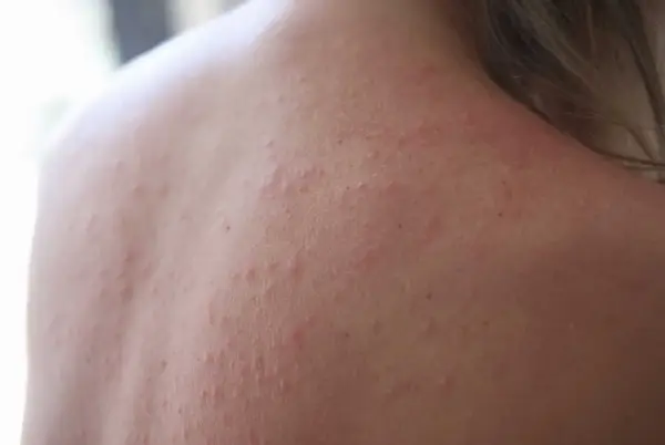 När solen bränner kan huden reagera med små röda prickar och utslag. Här ser du hur soleksem kan se ut på ryggen.