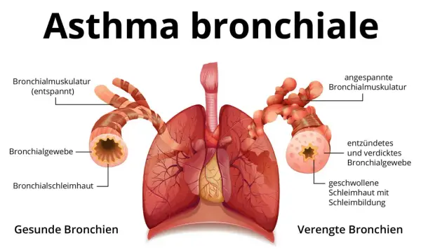 Vergleich gesunder und verengter Bronchien bei Asthma. Symptome wie angespannte Muskulatur und Schleimbildung führen zu Atemnot.