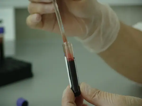 Rękawiczki ochronne i pipeta z krwią w probówce. P-lcr - analiza laboratoryjna.