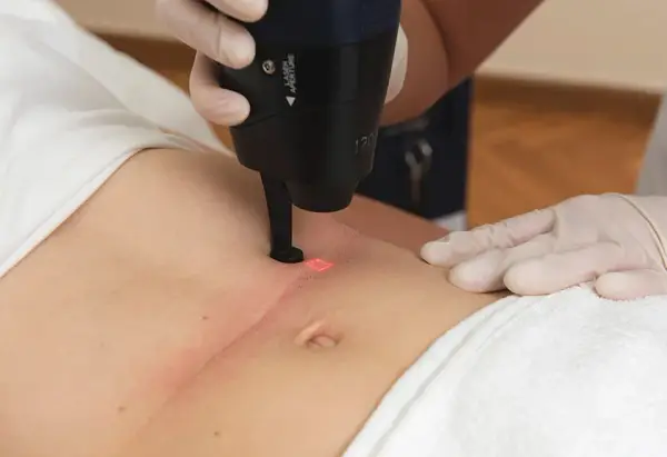 Jak się przygotować do laseru frakcyjnego, aby uniknąć problemów?