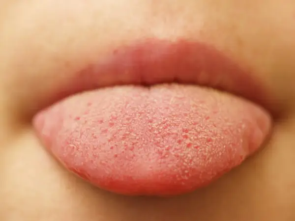 Lingua rossa con piccole bollicine, forse un bambino ha assaggiato qualcosa di nuovo e frizzante!