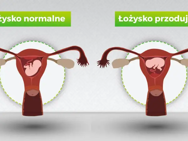 Porównanie: łożysko normalne vs łożysko przodujące. Na obrazku widać macicę z płodem. W przypadku łożyska przodującego, łożysko znajduje się na przedniej ścianie macicy.