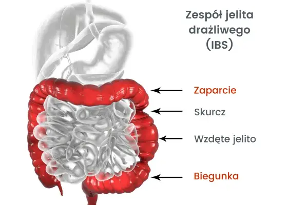 Jelito drażliwe: Objawy, typy, czerwone flagi. Kiedy do lekarza?