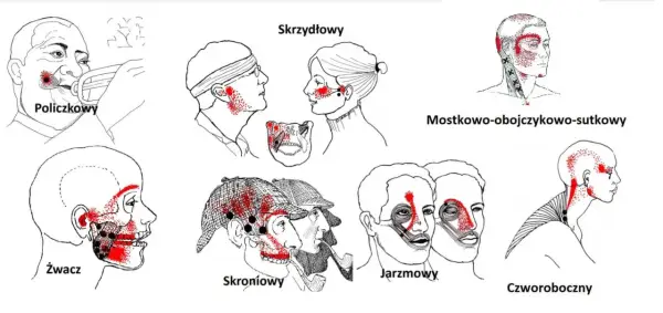 Ilustracje pokazują punkty bólu związane z różnymi typami bólu głowy, które mogą być mylone z objawami nowotworu stawu skroniowo-żuchwowego.