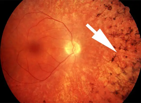 Retinite pigmentosa: sintomi visibili come depositi scuri sulla retina, indicati da una freccia bianca.